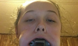 'Điên cuồng' với thần tượng, cô bé 14 tuổi bị kẹt cả cái búa trong miệng