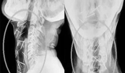 Các bác sĩ bất ngờ khi tìm thấy 150 cây đinh trong cơ thể 1 người đàn ông