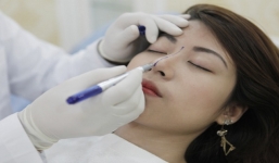 Quên miếng gạc trong mũi sau phẫu thuật thẩm mỹ,cô gái nhận cái kết đắng