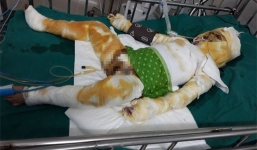 Bé trai bị bỏng nặng vì xem nướng mực, buộc cưa chân để cứu mạng sống