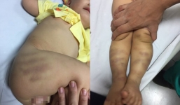 Bé trai bị bạo hành, bỏ lại bệnh viện đang nguy kịch