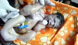 Bé trai sơ sinh có 4 chân, 3 tay may mắn được bác sĩ cứu chữa