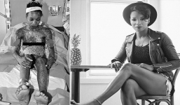 Ca sĩ trẻ ở Canada bỗng bị lở loét toàn thân vì dùng kháng sinh trong 10 ngày