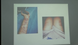 Không được đi du học, nữ sinh dùng dao lam cắt nát tay để xả stress