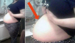 Người phụ nữ 'mang thai' 3 năm không đẻ, đến lúc mổ mới sững sờ