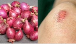 Mẹo đánh bay sẹo lồi tại nhà chỉ bằng 1 củ hành tím