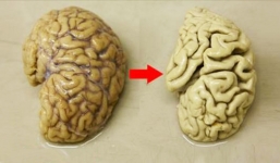 Khi cơ thể mệt và buồn ngủ thì não sẽ như thế nào?