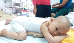 Bố mẹ mù để con bị bỏng sau đó bôi kem đánh răng và hậu quả đau lòng