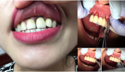 Rộ trào lưu bọc răng sứ chị em “ nước mắt chảy dài” khi mất cả hàm răng