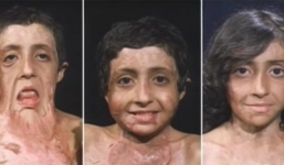 Con gái 9 tuổi bị biến dạng hoàn toàn khuôn mặt vì bỏng, người bố vẫn kiên trì tìm lại hình hài cho con và cái kết bất ngờ