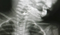 Lấy thành công kim băng trong thực quản bé trai 18 tháng tuổi