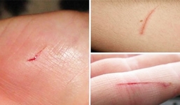 Bà mẹ ở Anh tử vong vì 1 vết xước ở tay