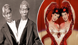 Cuộc sống của những cặp 'dị nhân' sinh đôi dính liền nổi tiêng khắp thế giới 