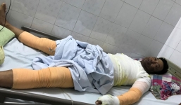 Bình ga bỗng dưng phát nổ, người đàn ông bị bỏng toàn thân cháy xém mặt