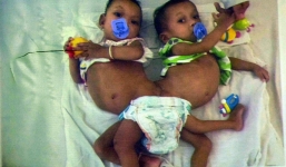 12 giờ cân não tách cặp song sinh dính liền hy hữu nhất Việt Nam