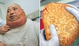 Người đàn ông bị đâm 7 nhát dao không chết nhờ “khối mỡ” nuôi nhiều năm