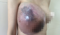 Vừa sinh con xong, người mẹ trẻ ở Hà Nội phải cắt bỏ một bên vú vì u Phyllode khổng lồ