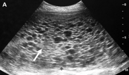 Mẹ 'chết lặng' khi đi siêu âm thai 12 tuần nhưng không thấy em bé