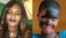 Bị gã chồng đổ axit, người phụ nữ hỏng hoàn toàn gương mặt, phải ăn và uống qua ống truyền