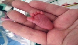 Sự sống sót kỳ diệu của bé sơ sinh nhỏ nhất thế giới nặng 229 g