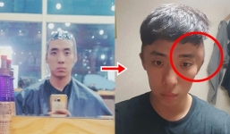 Nam thanh niên mặt biến dạng vì dị ứng thuốc nhuộm tóc