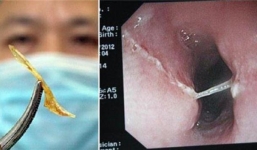 Mẹo chữa hóc xương cá cực hay bằng vỏ cam tại nhà
