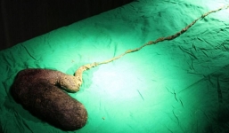 Cô gái trẻ mắc hội chứng lạ thích ăn tóc 