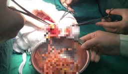 Hãi hùng ổ giun lớn gây  tắc ruột bé 3 tuổi