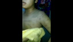 Bé trai 9 tuổi bị chính mẹ ruột bạo hành phải nhập viện cấp cứu