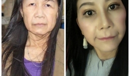 Cô gái 22 tuổi bị lão hóa như cụ bà 80 lột xác nhờ phẫu thuật thẩm mỹ