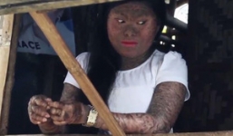 Thiếu nữ Philippines mọc vảy cá khắp người