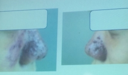 Suýt hoại tử mũi, hỏng mặt chỉ vì làm đẹp ở spa tại gia