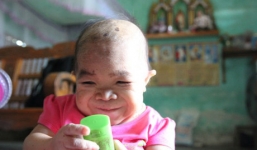 Người phụ nữ 27 tuổi mang bệnh lạ, sống trong thân hình bé gái 2 tuổi