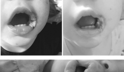 Bé gái suýt mất mạng vì ngậm dây sạc điện thoại