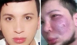 Chàng trai 28 tuổi bị biến dạng mặt vì độn má