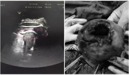 Thai nhi 'siêu quậy' đạp thủng tử cung mẹ, thò chân ra ngoài