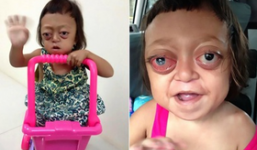 Mắc bệnh hiếm gặp, bé gái bị mẹ bán cho đám 'ma cô', ngày ngày chịu đòn để đi ăn xin 