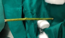 Tuyên Quang: Tự phá thai, cô gái trẻ suýt mất mạng