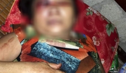 Truy tìm kẻ đánh người phụ nữ 65 tuổi hỏng một con mắt trên chiếu bạc