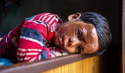 Không cưới được mẹ, đổ axit lên mặt con để trả thù