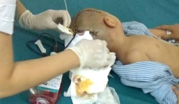 Bé trai 3 tuổi bị tụ máu 1/4 não phải mổ cấp cứu khi đi học tại trường mầm non