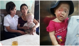 Xót xa cuộc đời bé gái 2 tuổi bạch tạng bị hỏng một mắt, sẹo bỏng chằng chịt khuôn mặt