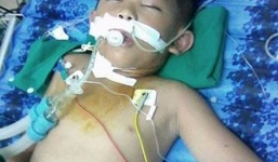 Bị đàn ong tấn công, cháu bé nhập viện trong tình trạng nguy kịch