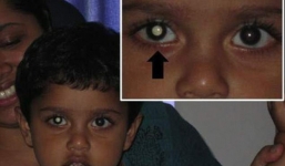 Bố mẹ phát hiện con mắc bệnh nguy hiểm khi chụp ảnh cho con