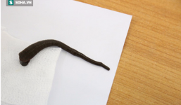 “Mai phục” suốt một giờ để gắp con đỉa dài 10cm trong khí quản người phụ nữ