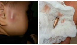 Đang ngồi trong lớp, cháu bé bị đạn rơi trúng đầu