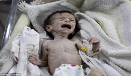 Cả thế giới rúng động trước hình ảnh em bé gầy trơ xương