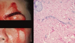 Chứng bệnh hiếm có kỳ lạ khiến cô gái này đổ máu thay mồ hôi