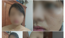 Con dâu bị nhà chồng đánh thâm tím vì từ chối nộp tiền hàng tháng cho mẹ chồng