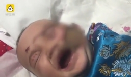 Ngã vào bếp sưởi, bé gái 5 tháng tuổi bị bỏng nặng